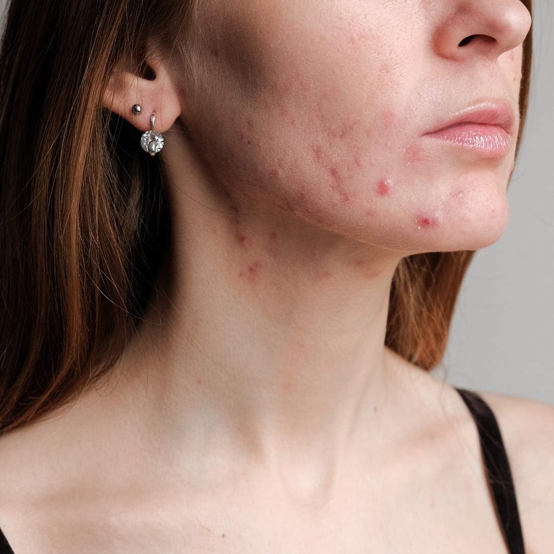 Hormonal Acne in Your 40s: Why It Happens and What Actually Helps