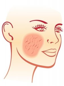 Read more about the article Retinaldehyde As A Rosacea Treatment