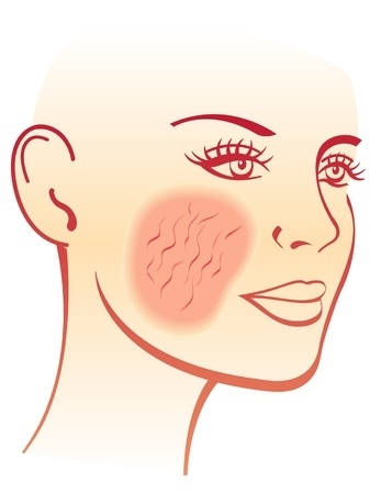 You are currently viewing Retinaldehyde As A Rosacea Treatment